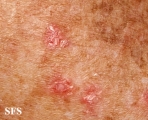 porokeratosis actinic