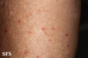 porokeratosis actinic