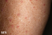 porokeratosis actinic