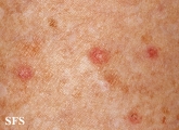porokeratosis actinic