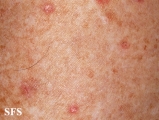 porokeratosis actinic