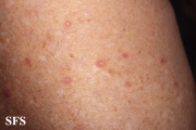 porokeratosis actinic