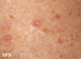 porokeratosis actinic