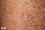 porokeratosis actinic