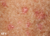 porokeratosis actinic