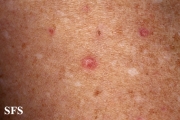 porokeratosis actinic