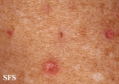 porokeratosis actinic