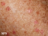 porokeratosis actinic
