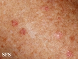 porokeratosis actinic