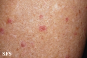 porokeratosis actinic