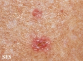 porokeratosis actinic