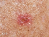 porokeratosis actinic