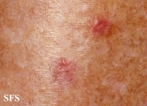 porokeratosis actinic