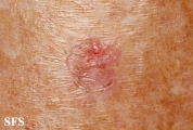 porokeratosis actinic