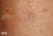 porokeratosis actinic