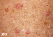 porokeratosis actinic