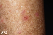 porokeratosis actinic