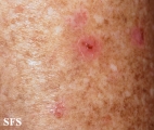 porokeratosis actinic