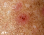 porokeratosis actinic