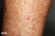 porokeratosis actinic