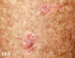 porokeratosis actinic