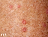 porokeratosis actinic