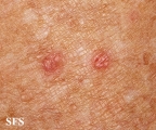porokeratosis actinic