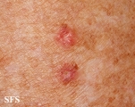 porokeratosis actinic