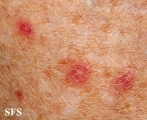 porokeratosis actinic