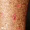 porokeratosis actinic