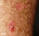 porokeratosis actinic