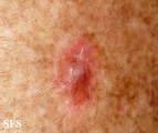 porokeratosis actinic