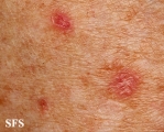 porokeratosis actinic
