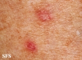 porokeratosis actinic