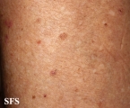 porokeratosis actinic