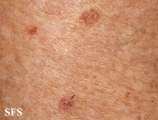 porokeratosis actinic