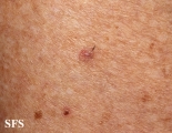 porokeratosis actinic