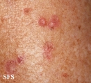 porokeratosis actinic