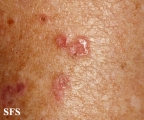 porokeratosis actinic