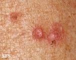 porokeratosis actinic