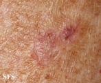 porokeratosis actinic