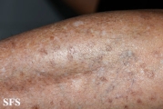 porokeratosis actinic