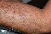 porokeratosis actinic