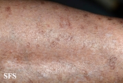 porokeratosis actinic