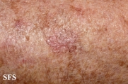 porokeratosis actinic