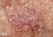 porokeratosis actinic