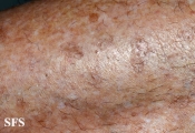 porokeratosis actinic