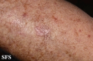 porokeratosis actinic