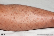 porokeratosis actinic