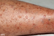 porokeratosis actinic